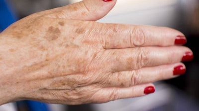 Melasma nas mãos: o que é e como diminuir